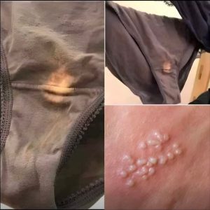 BE CAREFUL , If you spot these dots on your skin, it means you have Can…Read more